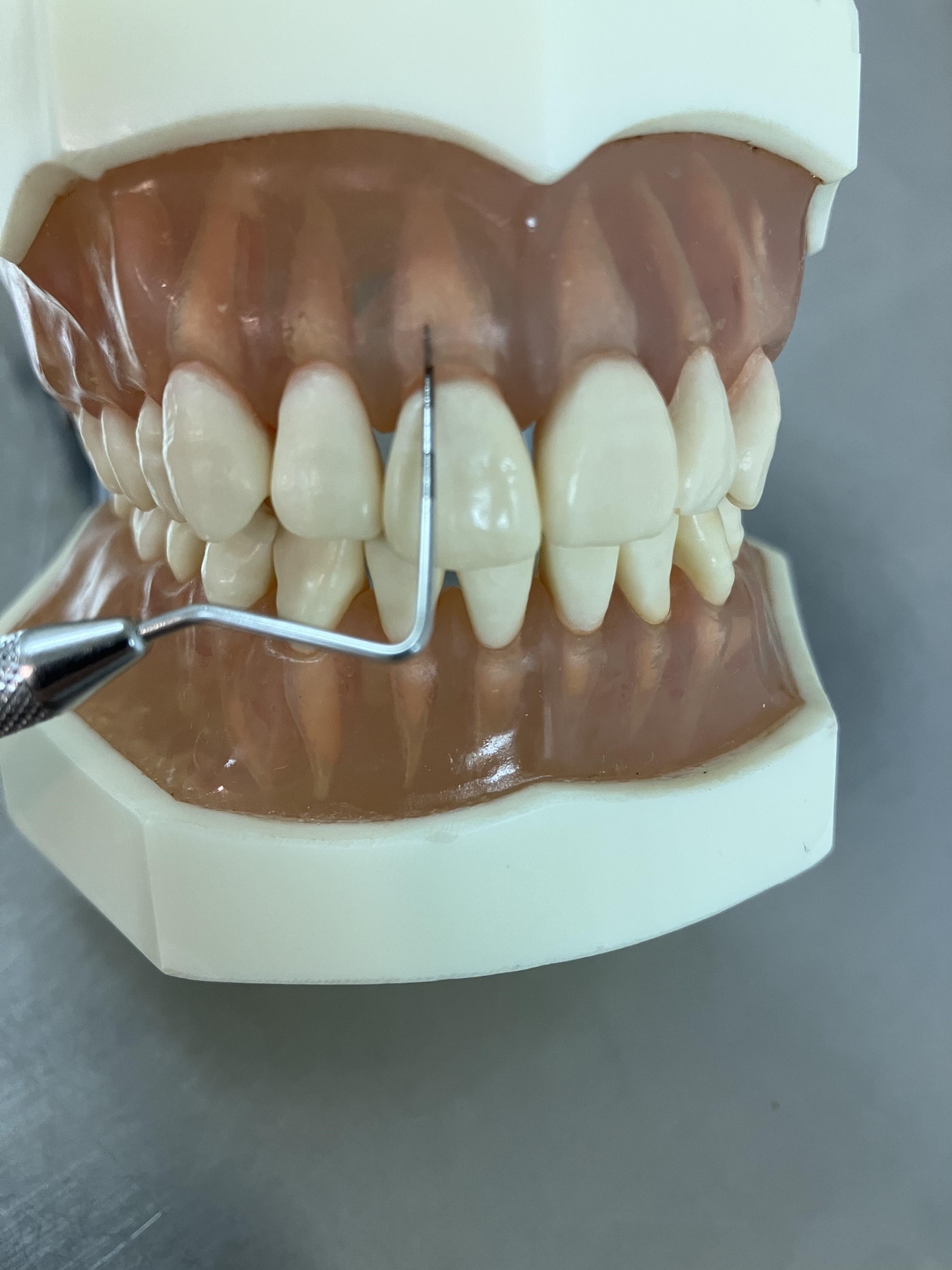 縁下スケーリング