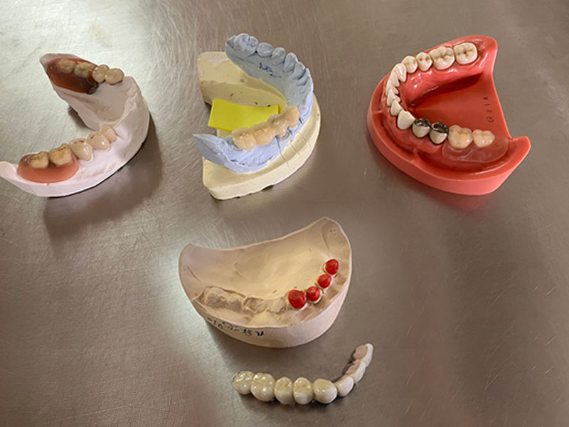 コーヌスブリッジ又は義歯